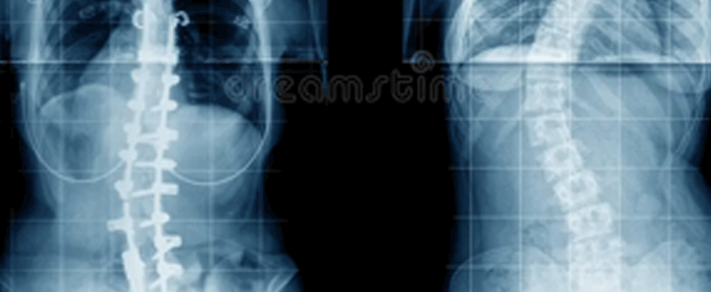 Side-by-side spinal X-rays showing scoliosis and fusion hardware